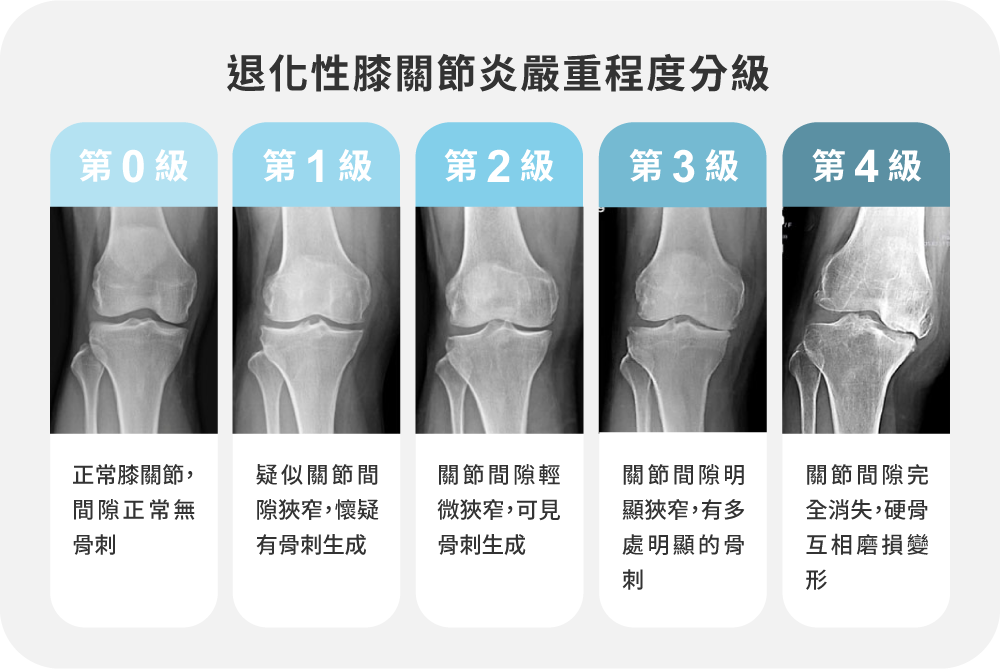 「退化性膝關節炎」嚴重程度分級